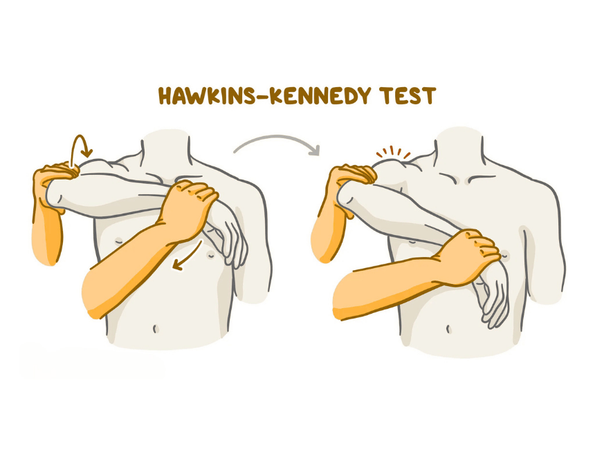 常用於檢查肩夾擠的測試: Hakwkins-Kennedy test 