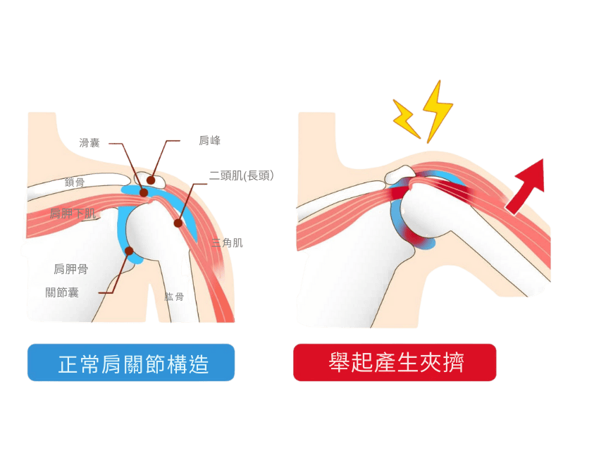 肩夾擠症候群發生的問題機轉