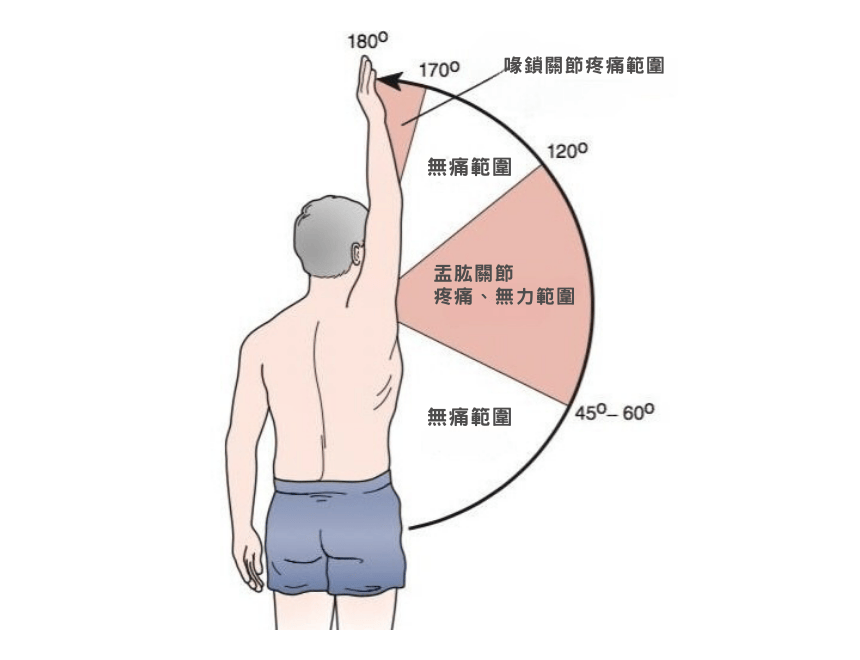 疼痛弧反應( Painful Arc sign ) 肩膀不舒服可能有的現象