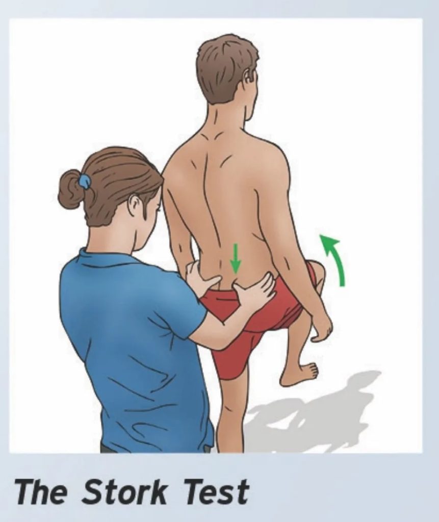 使用Stork test檢查薦髂關節、骨盆的活動度